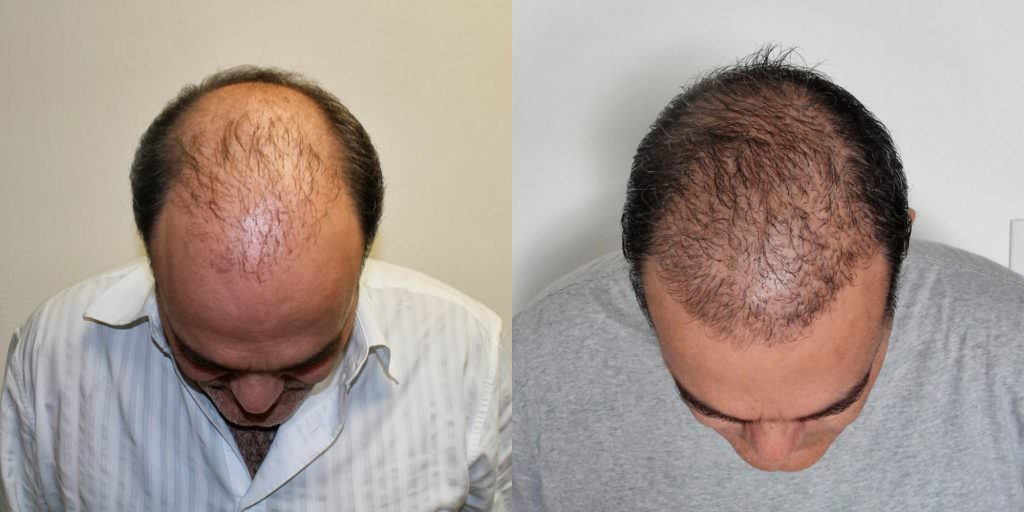 This Is The Most Effective Way To Restore Your Hair Before And Afters Crown Difficult Cases Hair Transplant Industry Exposed Hairline Healing/Growth Process MaxHarvest Plus™ Procedures 