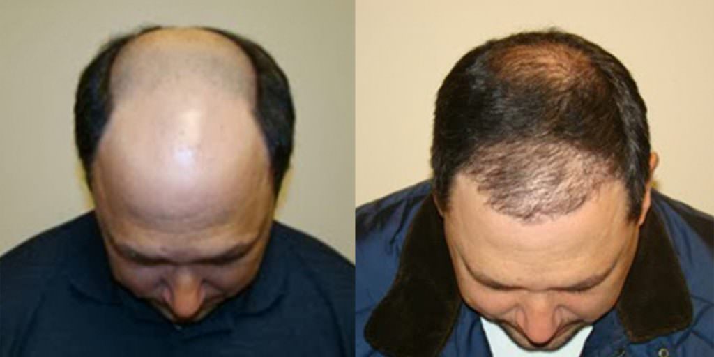 Get Rid Of Your Hair System With A Legitimate Hair Transplant Before And Afters Difficult Cases Hairline MaxHarvest Plus™ Procedures 