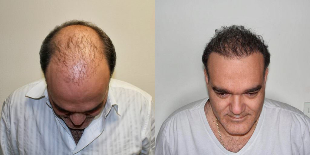This Is The Most Effective Way To Restore Your Hair Before And Afters Crown Difficult Cases Hair Transplant Industry Exposed Hairline Healing/Growth Process MaxHarvest Plus™ Procedures