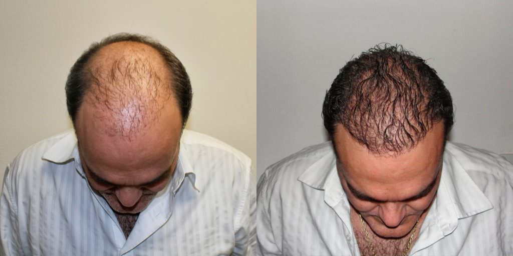 This Is The Most Effective Way To Restore Your Hair Before And Afters Crown Difficult Cases Hair Transplant Industry Exposed Hairline Healing/Growth Process MaxHarvest Plus™ Procedures 