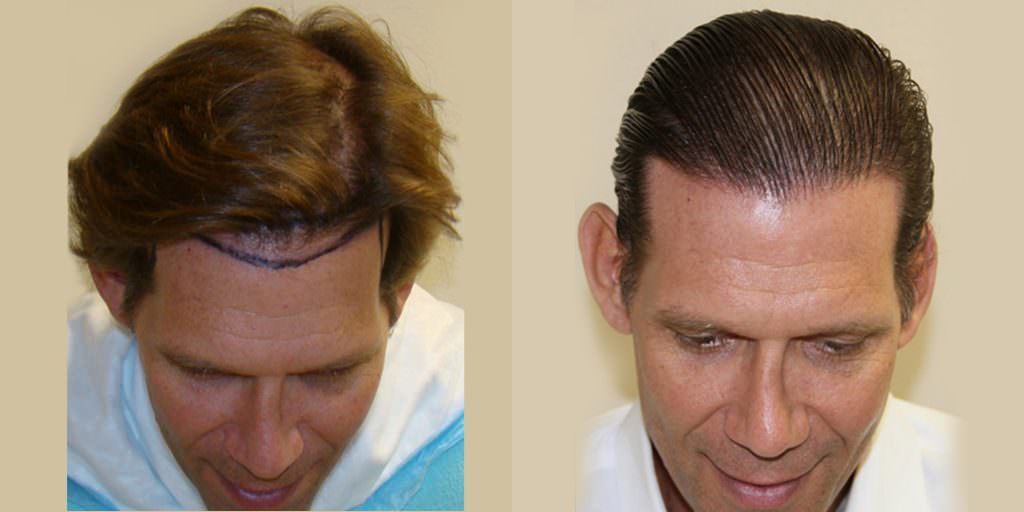 Dr. Bolton's Own Patient Advisor Gets A MaxHarvest™ Hair Transplant Before And Afters Hairline Healing/Growth Process Testimonials 