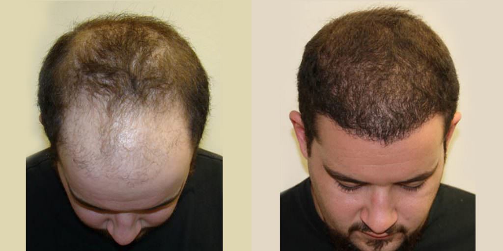 19 Year Old's Completely Restored Look After Hair Transplant Before And Afters Crown Difficult Cases Hairline Testimonials