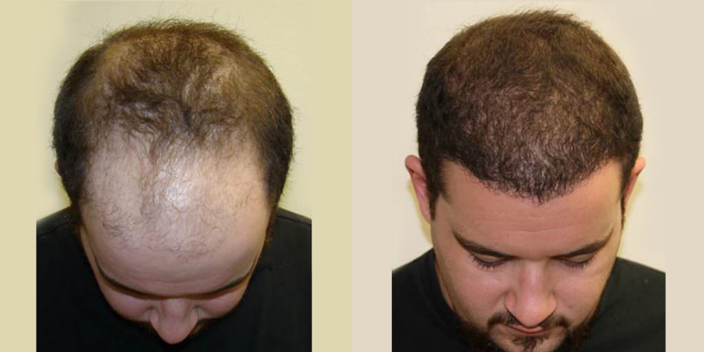 19 Year Old's Completely Restored Look After Hair Transplant Before And Afters Crown Difficult Cases Hairline Testimonials 