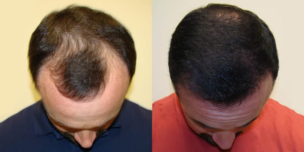 How To Reverse Balding In One MaxHarvest™ Procedure Before And Afters Hairline Testimonials 