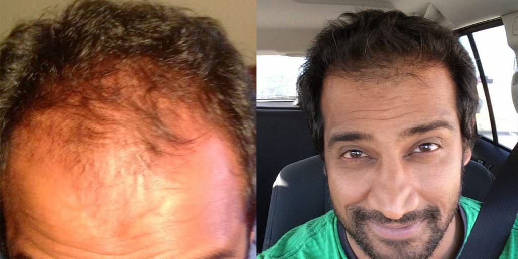 Hairline-Focused Hair Transplant Procedure Before And Afters Hairline Healing/Growth Process 