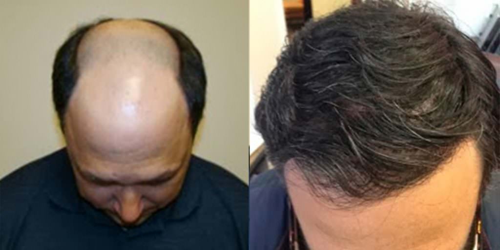 Get Rid Of Your Hair System With A Legitimate Hair Transplant Before And Afters Difficult Cases Hairline MaxHarvest Plus™ Procedures