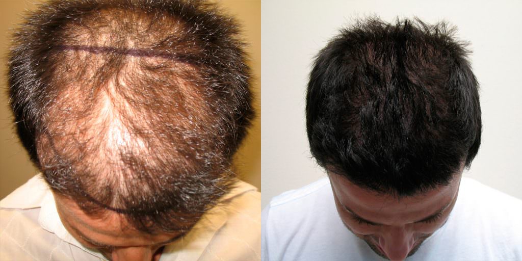 5 Years After Hair Transplant Follow-Up Before And Afters Hairline Healing/Growth Process