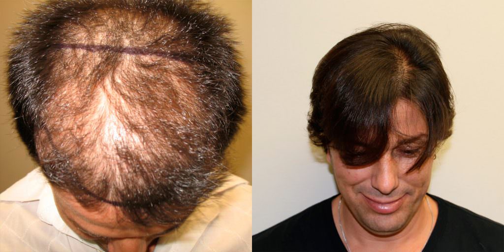 5 Years After Hair Transplant Follow-Up Before And Afters Hairline Healing/Growth Process 