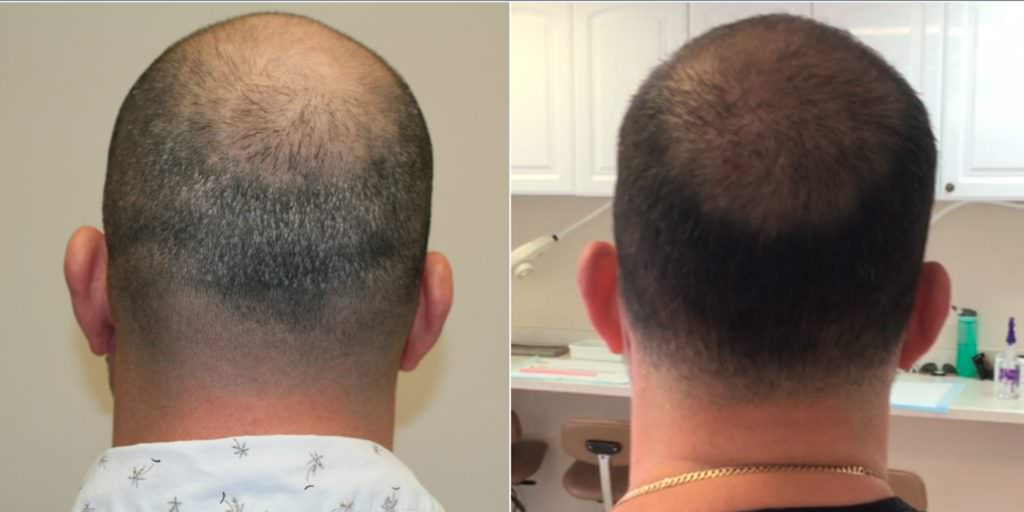 The Largest Case In GHT History! Before And Afters Crown Difficult Cases FUE Corrections Hair Transplant Industry Exposed Hairline Healing/Growth Process MaxHarvest Plus™ Procedures Testimonials 