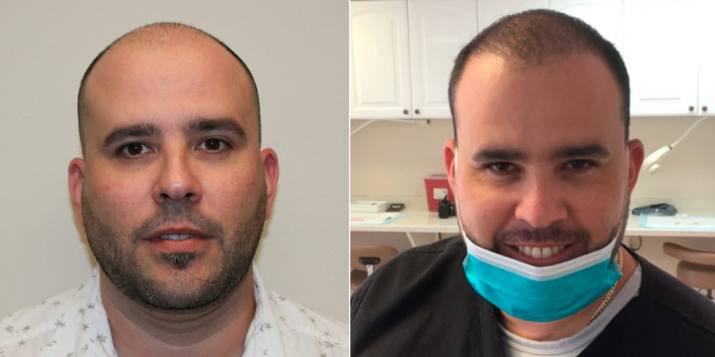 The Largest Case In GHT History! Before And Afters Crown Difficult Cases FUE Corrections Hair Transplant Industry Exposed Hairline Healing/Growth Process MaxHarvest Plus™ Procedures Testimonials 