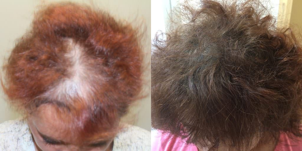 Full Hair Restoration, Regardless of Gender Before And Afters Hairline Women 