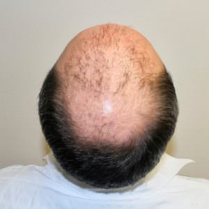 This Is The Most Effective Way To Restore Your Hair Before And Afters Crown Difficult Cases Hair Transplant Industry Exposed Hairline Healing/Growth Process MaxHarvest Plus™ Procedures 