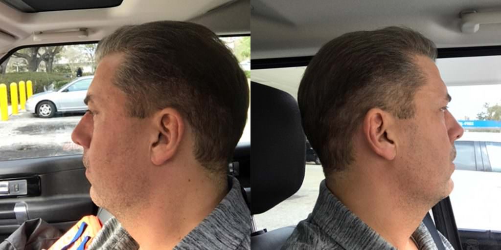 Density Improvement Across Entire Head With MaxHarvest Plus™ Hair Transplant Before And Afters Crown Difficult Cases MaxHarvest Plus™ Procedures 