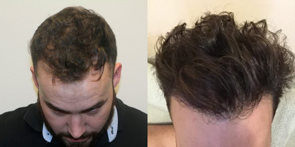 Another Masterful Hairline Restoration Before And Afters Hairline 