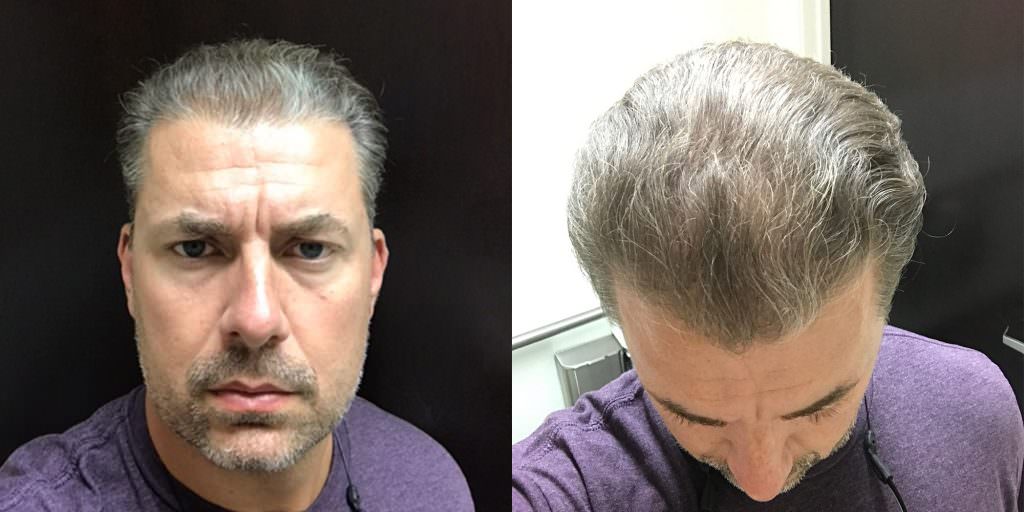 Density Improvement Across Entire Head With MaxHarvest Plus™ Hair Transplant Before And Afters Crown Difficult Cases MaxHarvest Plus™ Procedures