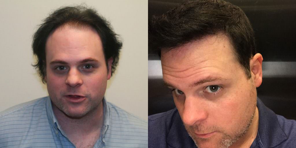 Tony's Continued Progress - Update 5 1/2 Months After Second Procedure! Before And Afters Hairline Healing/Growth Process 