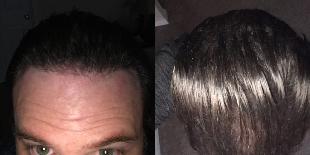 Tony's Continued Progress - Update 5 1/2 Months After Second Procedure! Before And Afters Hairline Healing/Growth Process