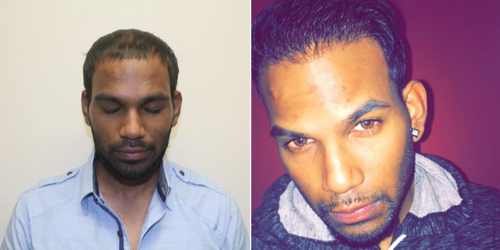 Dramatic Hair Transplant Result -Full Head Thickening! Before And Afters Difficult Cases Hairline 