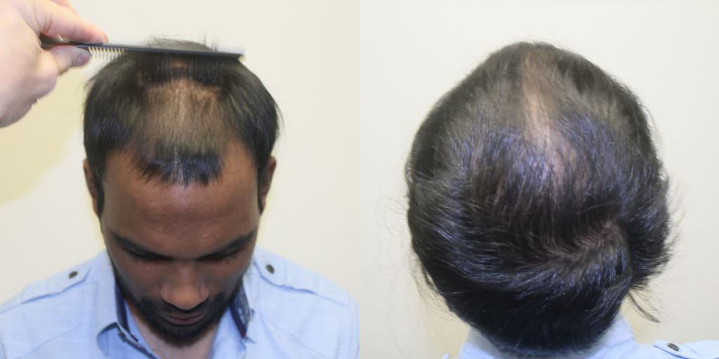 Dramatic Hair Transplant Result -Full Head Thickening! Before And Afters Difficult Cases Hairline 