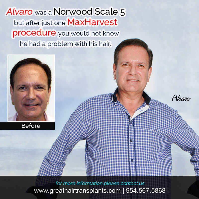 Alvaro - Hair Transplant Update! Before And Afters Difficult Cases Hairline Short Videos 