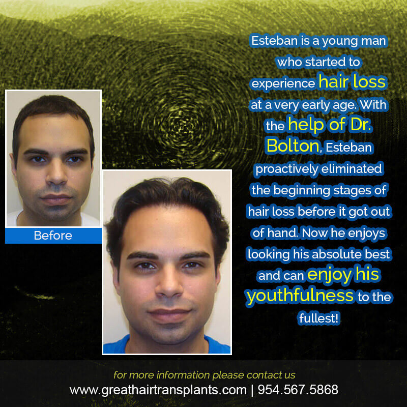 Esteban's Story: Combating early hair loss proactively Before And Afters Difficult Cases Hairline Short Videos 