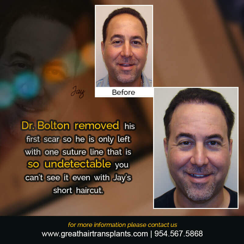 Jay - Hair Transplant Update! Before And Afters Difficult Cases Hairline Short Videos 