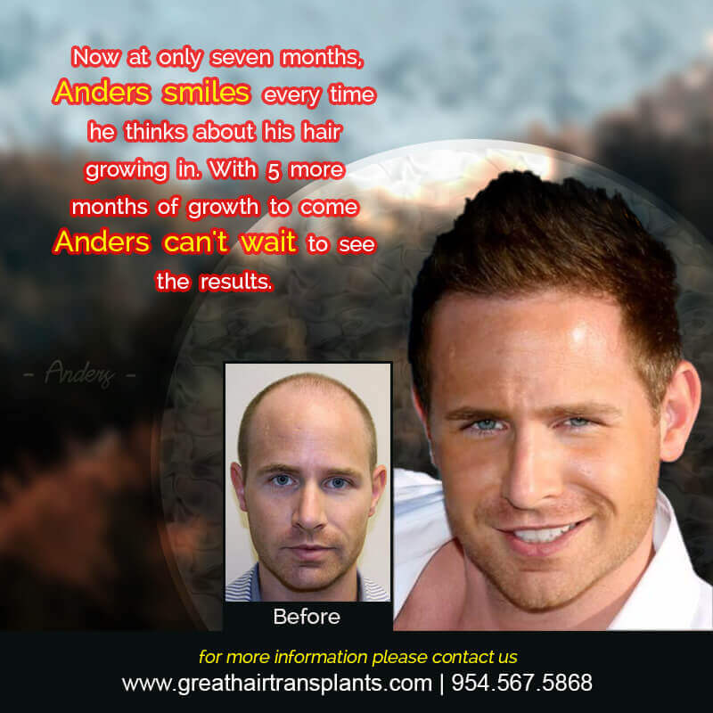 Anders's Story: From Bald to Hip Before And Afters Difficult Cases Hairline Short Videos 