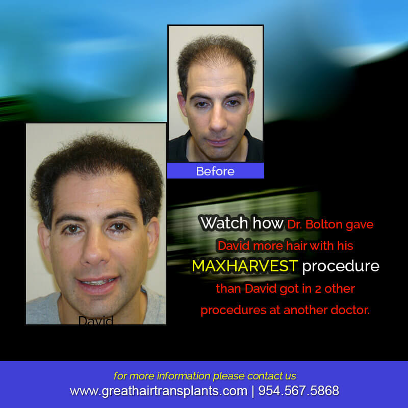 David's Hair  Transplant Story Before And Afters Difficult Cases Hairline Short Videos 