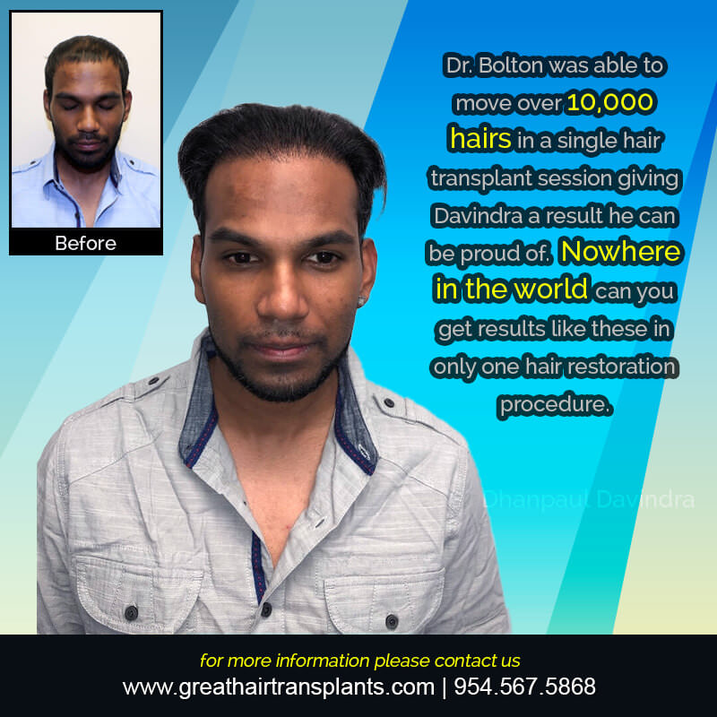 Davindra's Hair  Transplant Story Before And Afters Difficult Cases Hairline Short Videos 