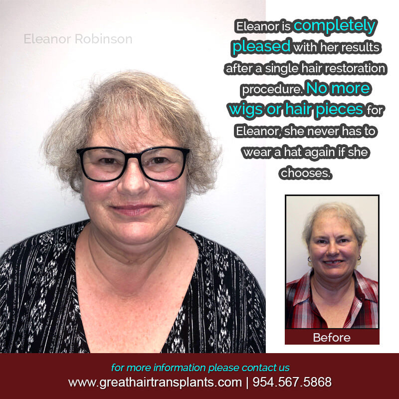 Eleanor's Hair Transplant Story Before And Afters Difficult Cases Hairline Short Videos