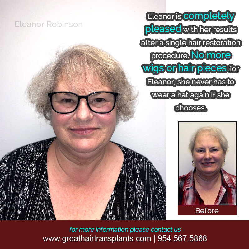 Eleanor's Hair  Transplant Story Before And Afters Difficult Cases Hairline Short Videos 