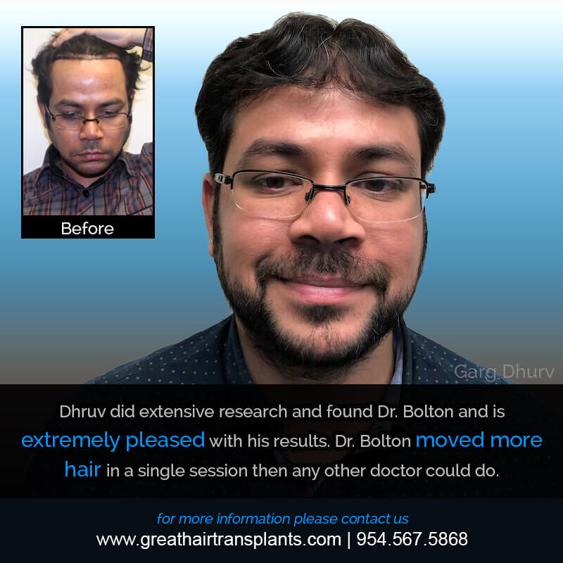 Dhruv's Hair Transplant Story Before And Afters Difficult Cases Hairline Short Videos
