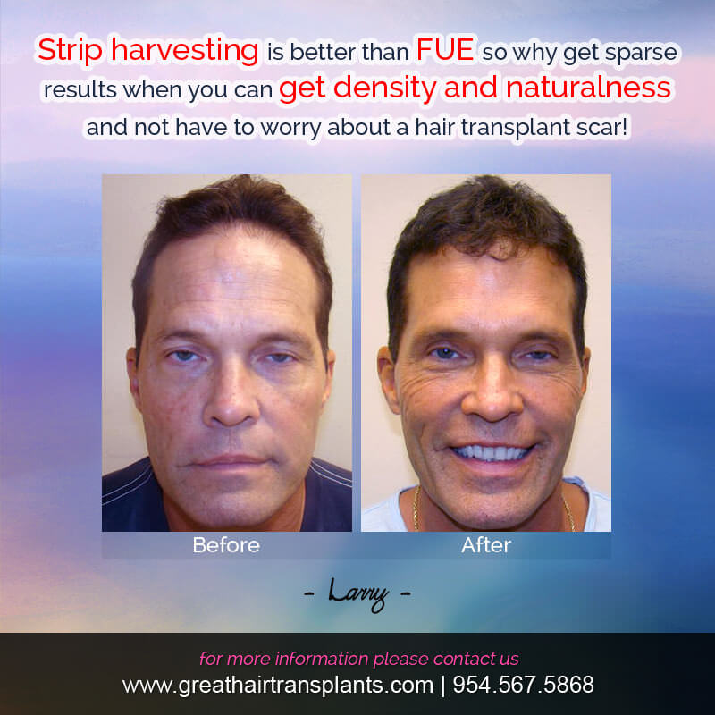 Larry - Hair Transplant Update! Before And Afters Difficult Cases Hairline Short Videos 