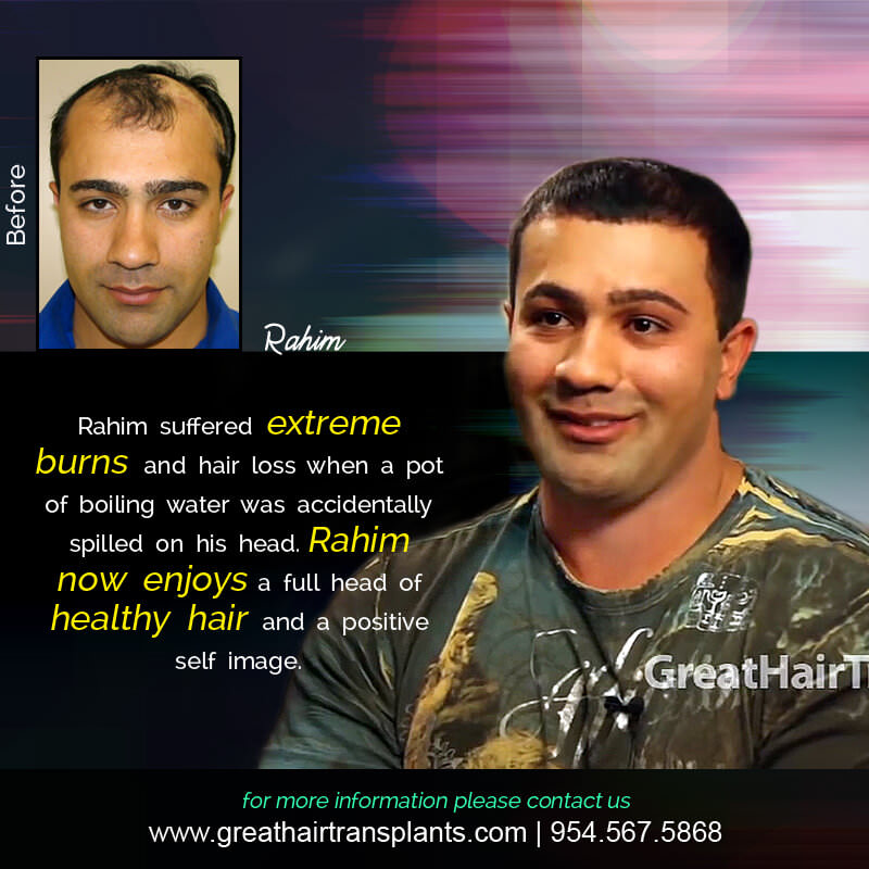Rahim - Hair Transplant Update! Before And Afters Difficult Cases Hairline Short Videos