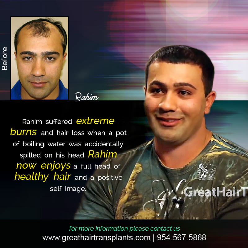 Rahim - Hair Transplant Update! Before And Afters Difficult Cases Hairline Short Videos 