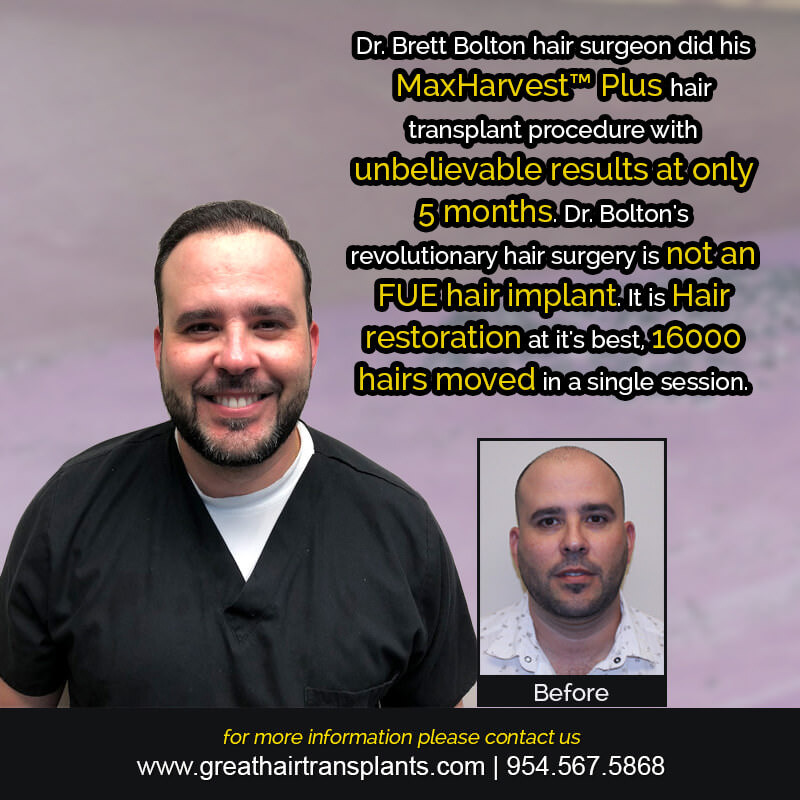 Adrien's Hair Transplant Story Before And Afters Difficult Cases Hairline Short Videos