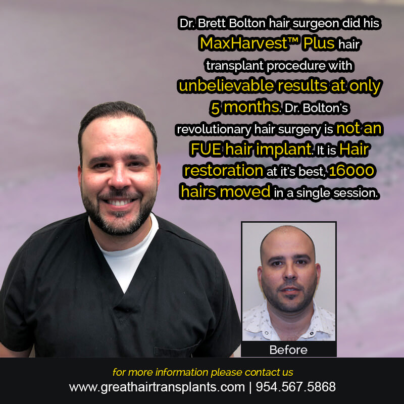 Adrien's Hair  Transplant Story Before And Afters Difficult Cases Hairline Short Videos 