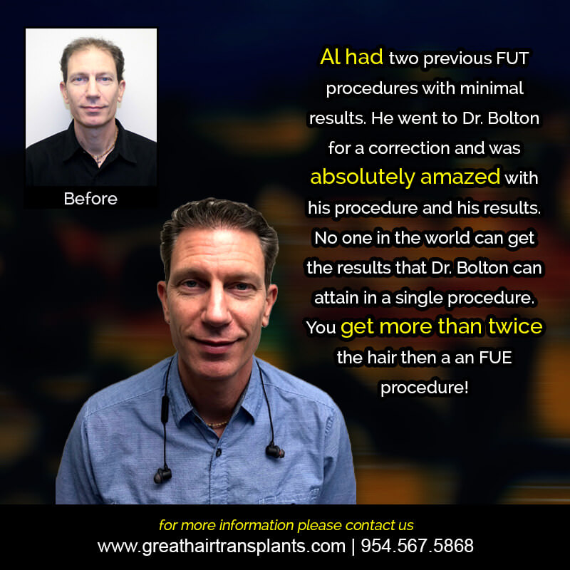 Al's Hair Transplant Story Before And Afters Difficult Cases Hairline Short Videos