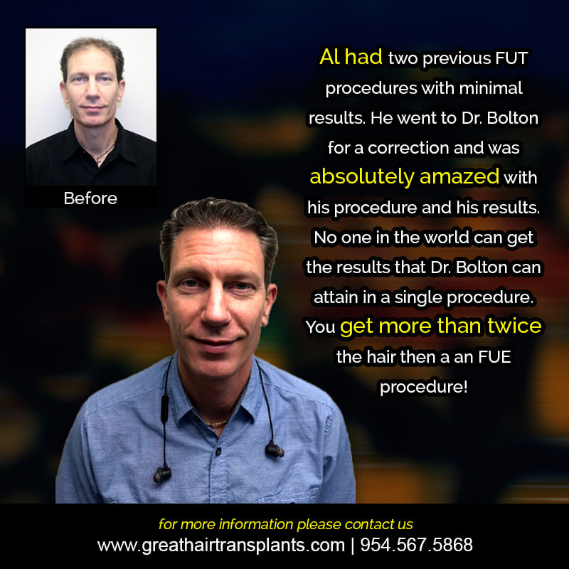 Al's Hair  Transplant Story Before And Afters Difficult Cases Hairline Short Videos 