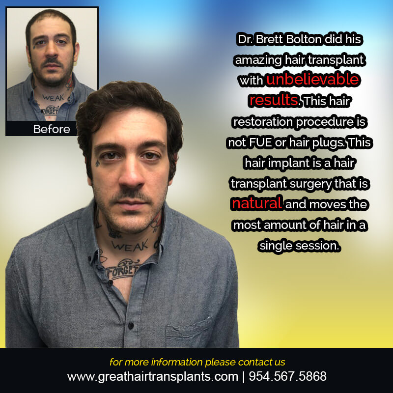 Marc's Hair  Transplant Story Before And Afters Difficult Cases Hairline Short Videos 