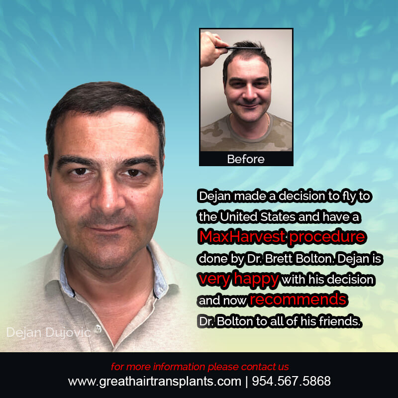 Dejan's Hair Transplant Story Before And Afters Difficult Cases Hairline Short Videos