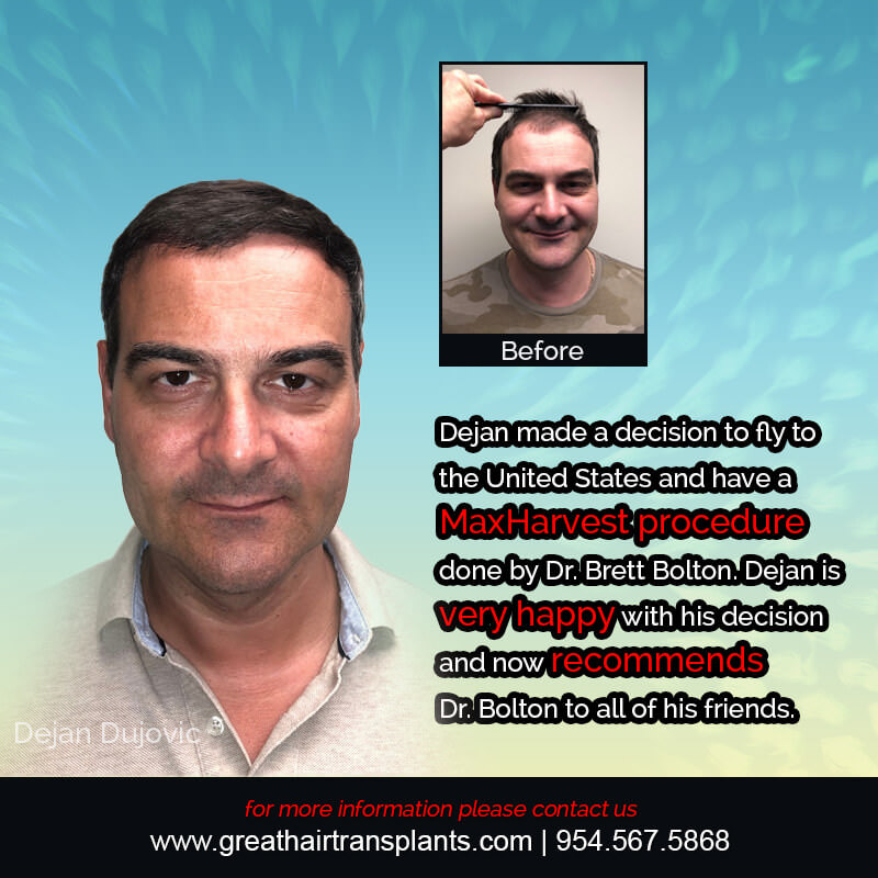 Dejan's Hair  Transplant Story Before And Afters Difficult Cases Hairline Short Videos 