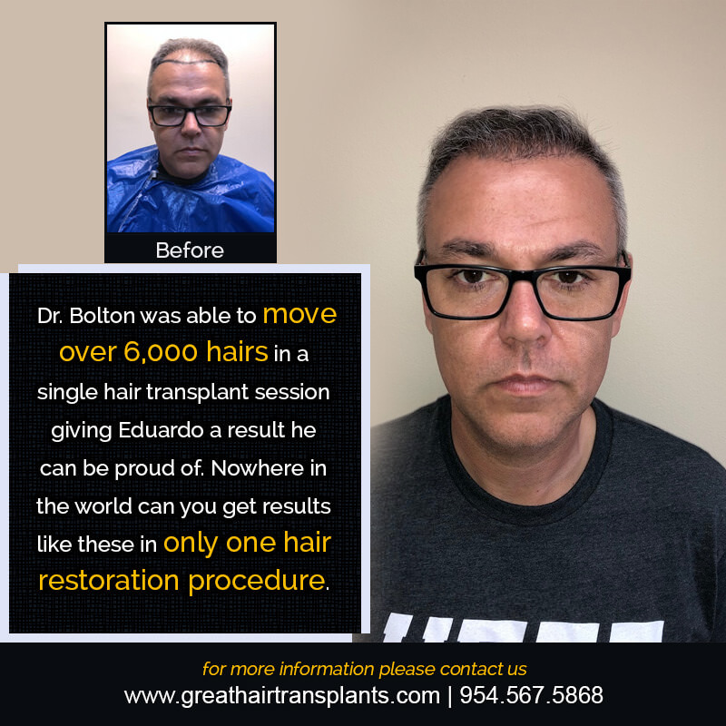 Eduardo's Hair  Transplant Story Before And Afters Difficult Cases Hairline Short Videos 