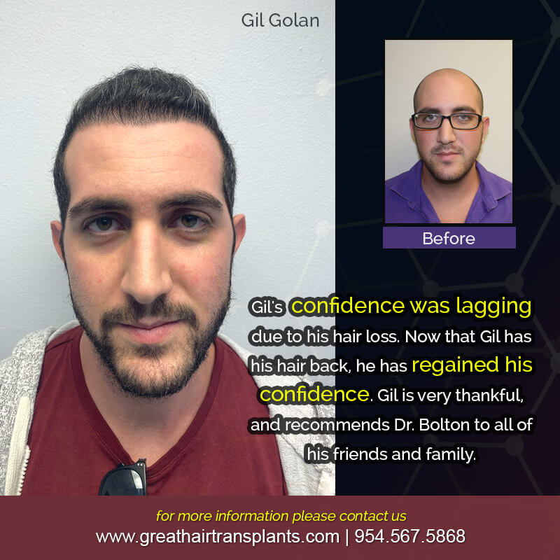 Gil's Hair  Transplant Story Before And Afters Difficult Cases Hairline Short Videos 