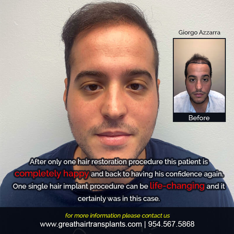 Giorgio's Hair Transplant Story Before And Afters Difficult Cases Hairline Short Videos