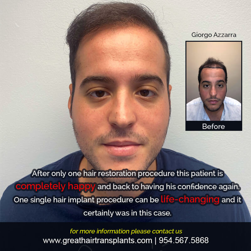 Giorgio's Hair  Transplant Story Before And Afters Difficult Cases Hairline Short Videos 