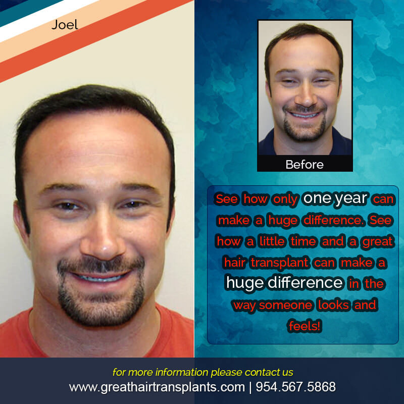 Joel's Hair  Transplant Before And Afters Difficult Cases Hairline Short Videos 