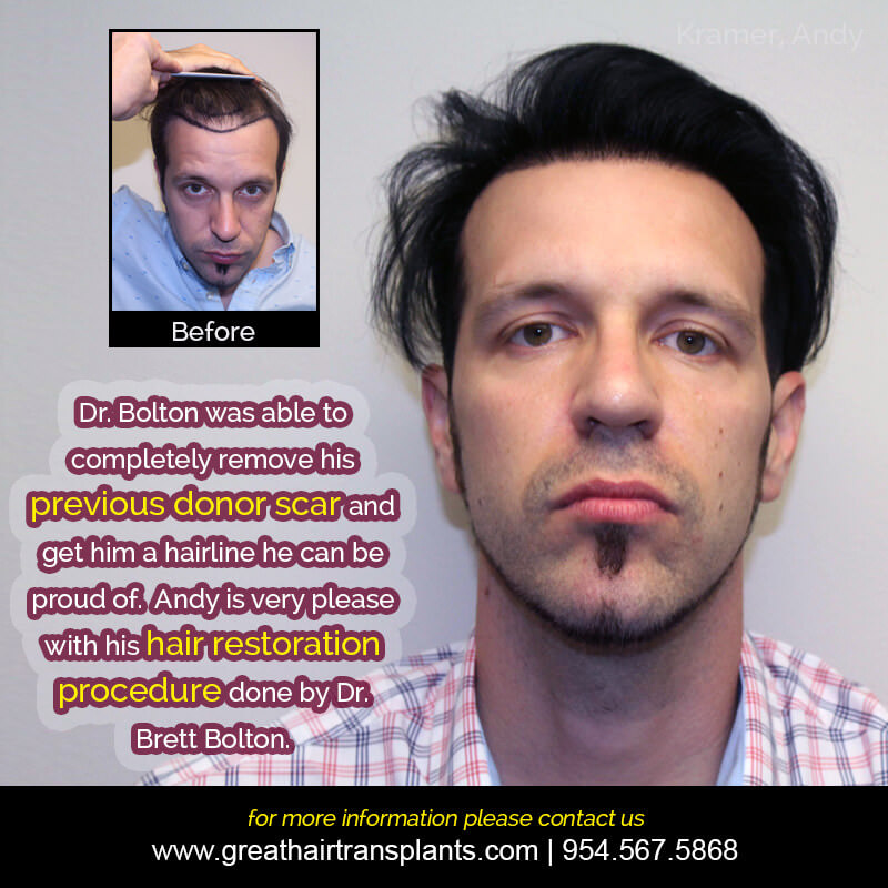 Andy's Hair  Transplant Story Before And Afters Difficult Cases Hairline Short Videos 