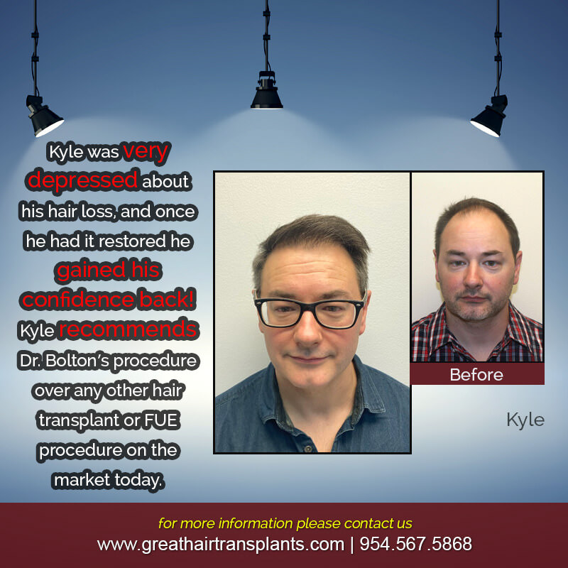 Kyle's Hair Transplant Story Before And Afters Difficult Cases Hairline Short Videos