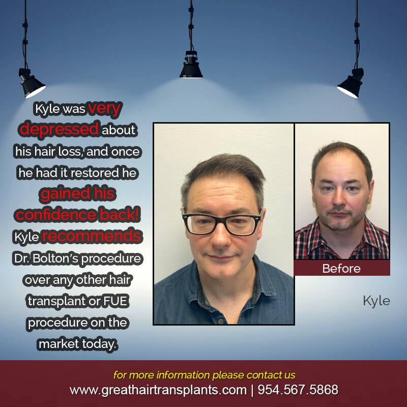 Kyle's Hair  Transplant Story Before And Afters Difficult Cases Hairline Short Videos 